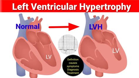 left ventricular hypertrophy risk factors.